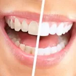 ata dentara, modul de utilizare și de a alege