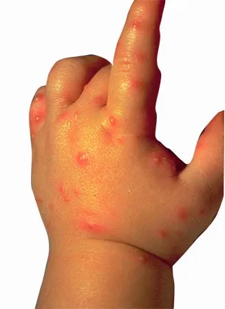 Alergic la mușcăturile de ploșnițe decat periculoase (mușcături) Alergic la mușcăturile de ploșnițe decât periculoase