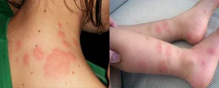 Alergic la mușcăturile de simptome ploșnițe, tratament (ploșnițe) Alergic la mușcăturile de simptome ploșnițe, tratament