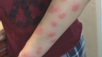 Alergic la mușcăturile de ploșnițe la copii și adulți cum să se uite și ce să trateze (în jurul locul muscaturii) Alergic la mușcăturile de ploșnițe la copii și adulți cum să se uite și cum să trateze