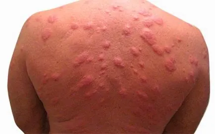 Alergic la mușcăturile de ploșnițe decât periculoase (ploșnițe) Alergic la mușcăturile de ploșnițe decât periculoase