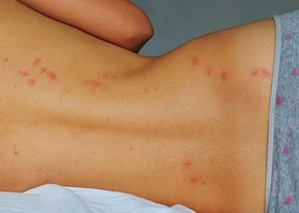 Alergic la mușcăturile de ploșnițe cauze, simptome, tratament (ploșnițe) Alergic la mușcăturile de ploșnițe cauze, simptome, tratament