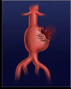 Abdominale simptome anevrism aortic, diagnostic, tratament