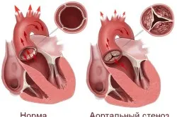 simptome aortic boli de inima si tratament
