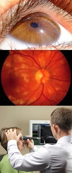Retiniana angiopatia - tipuri, cauze, simptome, diagnostic si metode de tratament (tipuri) Retiniana angiopatie - tipuri, cauze, simptome, diagnostic si metode de tratament