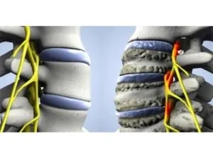 Osteoartrita a coloanei cervicale cauze, simptome, tratament