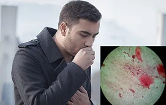 sânge Angina - de ce apare in gat si sputa (de ce) sânge Angina - de ce apare în gât și sputa