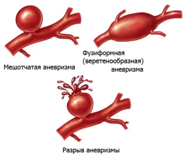 anevrism aortic abdominal sunt introduse la simptome precoce și tratament