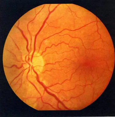 angiopatia vasculare retiniene cauze tratament ochi (vasele) angiopatia vasculare retiniene cauze tratament ochi
