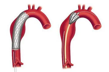 Abdominale simptome anevrism aortic, diagnostic, tratament