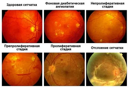 angiopatie retiniana ce este, cauze, simptome și tratament