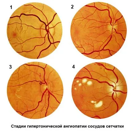 angiopatie retiniana ce este, cauze, simptome și tratament