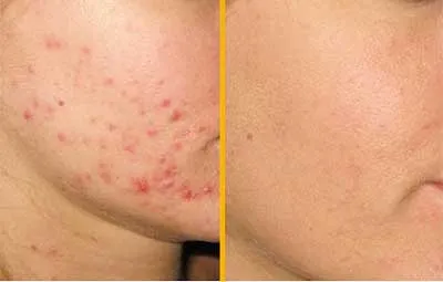 petelor albe in interiorul pielii - cauzele, subcutanate și ascunse (alb) petelor albe in interiorul pielii - cauzele, subcutanate și ascunse