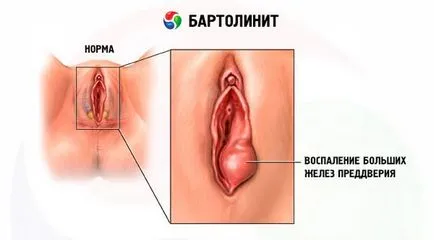 femei Bartolini - fotografii, simptome, tratament