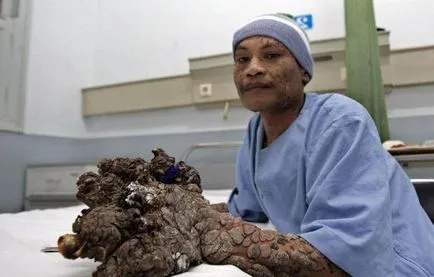 istoricul bolii-persoană copac, cauzele și faptele medicale (boala persoană copac boală om copac ca un om trăiește un copac) Arborele boală persoană poveste, motivele și faptele medicale