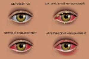 globul ocular Sore este important să se cunoască cauza și ce să facă