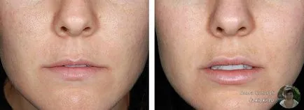 Răspunsurile Botox faciale și posibilele consecințe negative (negativ) raspunsuri faciale cu botox și posibilele consecințe negative,