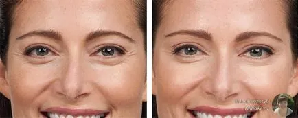 Răspunsurile Botox faciale și posibilele efecte adverse (răspunsuri) raspunsuri faciale cu botox și posibilele consecințe negative,