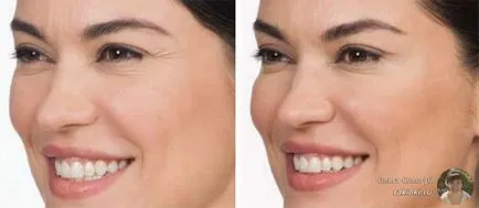 Răspunsurile Botox faciale și posibilele efecte adverse (răspunsuri) raspunsuri faciale cu botox și posibilele consecințe negative,