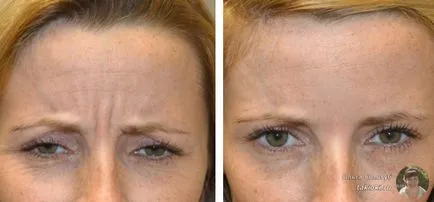 Botox raspunsuri faciale si posibilele efecte adverse (consecințe) raspunsuri faciale cu botox și posibilele consecințe negative,