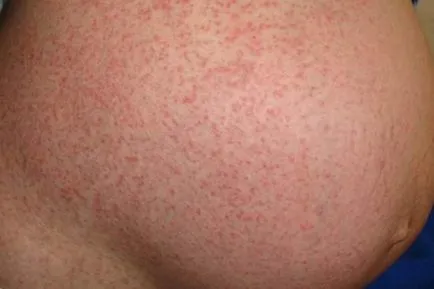 Sarcina fata si psoriazisul, tratamentul psoriazisului in timpul sarcinii, psoriazis, postpartum decat (agravarea psoriazisului după naștere) Ceea ce amenință sarcina și psoriazis, tratamente psoriazis in timpul sarcinii, psoriazis după nașterea copilului decât
