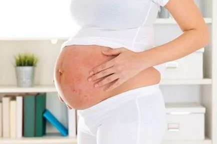 Sarcina fata si psoriazisul, tratamentul psoriazisului in timpul sarcinii, psoriazis, postpartum decat (tratamentul psoriazisului la gravide) Ceea ce amenință sarcina și psoriazis, tratamente psoriazis in timpul sarcinii, psoriazis după nașterea copilului decât