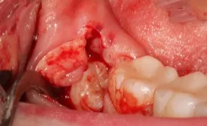 Cât de multe puteți mânca și bea după extracția dentară