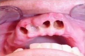 Cât de multe puteți mânca și bea după extracția dentară