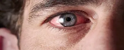 Ce ar trebui să fac în cazul în care ochii inflamat de sudură arsuri (ochi) Ce ar trebui să fac în cazul în care ochii inflamat de sudură arsură