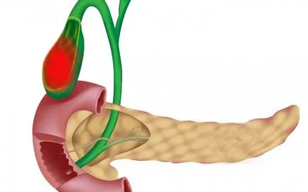 Ceea ce face ca bila, recuperarea nanotehnologie de sănătate fără medicamente (bilă de scurgere) Ceea ce face ca bila, recuperarea nanotehnologie de sanatate fara medicamente