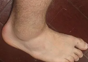 Ce să facă primul ajutor și tratament (tratamentul luxației piciorului) la tracțiune ligamentului picior Ce să faci când a ligamentelor intinse ale ajutorului primul picior și tratament