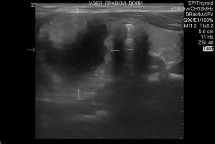 Ce se va tiroidiene cu ultrasunete