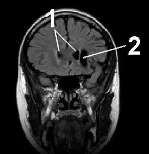 Ce este un chist plex vascular al creierului la om (chisturi) Ce este un chist plex vascular al creierului la om
