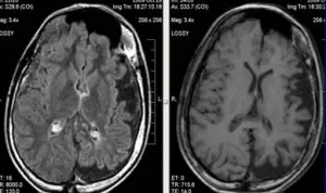 Ce este un chist plex vascular al creierului la om (Brain) Ce este un chist plex vascular al creierului la om