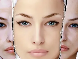 Ce este RF-facelift și care într-adevăr nevoie de ea (RF de ridicare față a gâtului și a decolteului) Ce este RF-facelift și care într-adevăr nevoie de ea