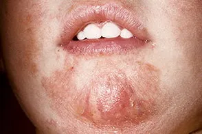 dermatita simplu