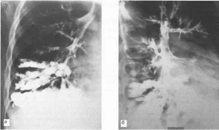 Diagnosticul de bronșiectazie