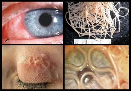 Dirofilariasis la oameni simptome și tratament