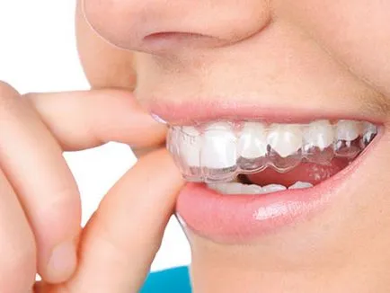 Aligner pentru alinierea dintilor descriere, imagini înainte și după