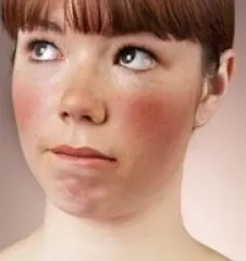 Erytrophobia (sindromul blashing) - tratament, simptome, chirurgie