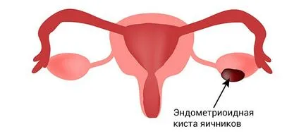 chist ovarian endometrioid - cauzele, tratamente, semne (un chist) chist ovarian endometrioid - cauzele, tratamente, simptome