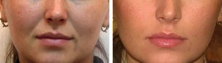 teosial Filler (Teosyal)