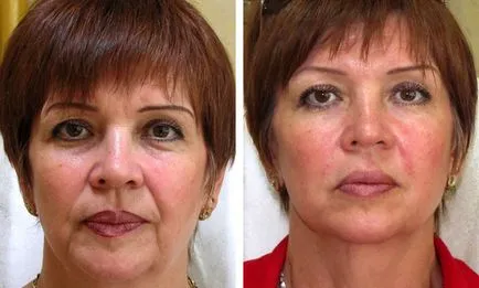teosial Filler (Teosyal)