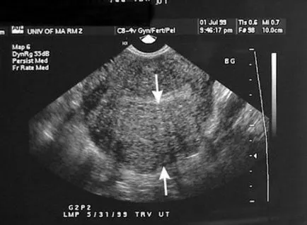 Ehopriznaki adenomioza, ea