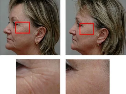 teosial Filler (Teosyal)