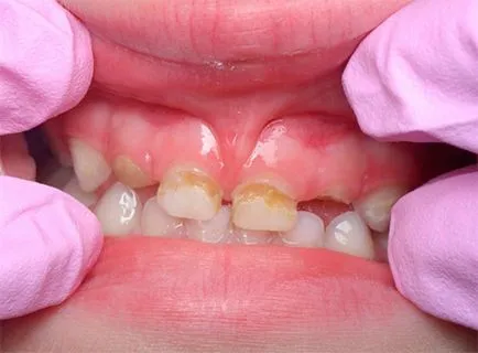 Fluorizări sau argint pentru copii dintii copilului dumneavoastră că este mai bine să aleagă