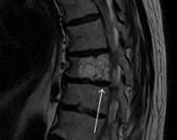 spinal hemangiom - cauze, simptome, diagnostic și tratament