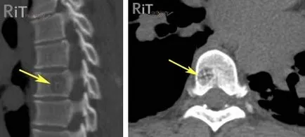 hemangiom a coloanei vertebrale, care este, ceea ce este periculos, tratament (rădăcini măduva spinării) hemangiom a coloanei vertebrale, care este, ceea ce este periculos, tratament