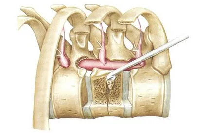 hemangiom a coloanei vertebrale, care este, ceea ce este periculos, tratament (rădăcini măduva spinării) hemangiom a coloanei vertebrale, care este, ceea ce este periculos, tratament