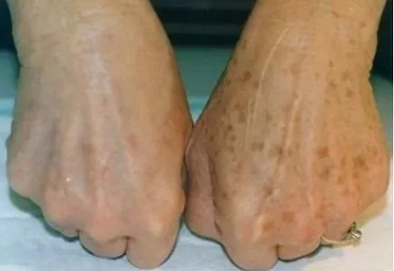 Cauze hiperpigmentare, simptome si tratament (persoana) Cauze hiperpigmentare, simptome și tratament